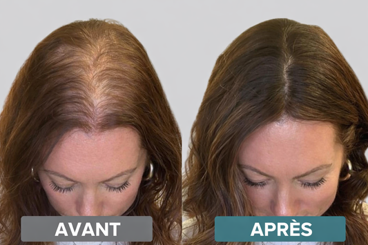 Avant après utilisation d’un masseur cuir chevelu contre la chute de cheveux